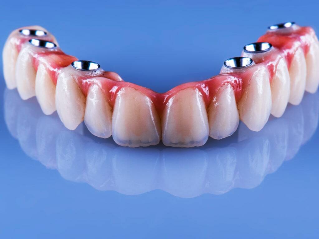 bridge_dentaire_complet_sur_implants